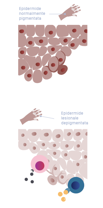 INT2213_Inctye_Vitiligo_Website_Graphics_Italian_R1V3_Complex_Disease_Mobile_0.png